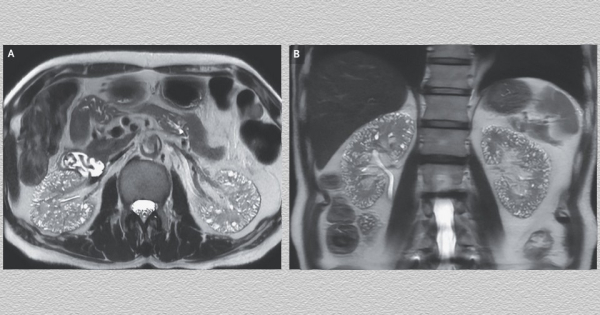 Литий и микрокисты почек: случай&hellip;