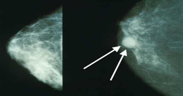 Эстроген-гестагенные препараты увеличили риск развития раннего рака груди. А эстрогенные препараты его снизили 6 af76583cb9b7a11b647a8f9d2e0c5d37.jpg