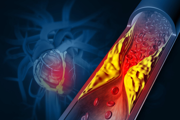 «Почти все россияне после 45 должны принимать статины». Кардиолог — о препаратах от холестерина