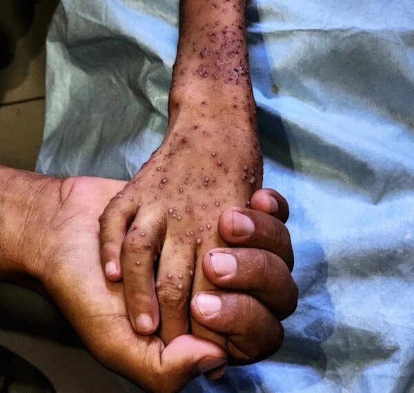 Серьёзные долгосрочные последствия кризиса недоедания&hellip;