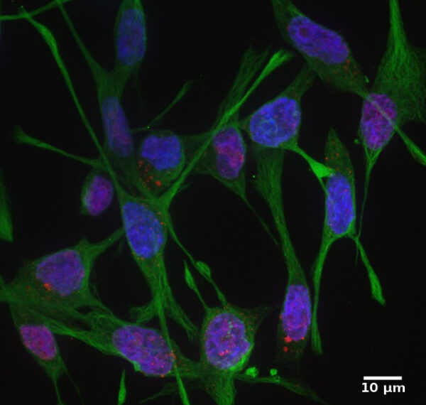 Раковые клетки подключаются к нейронам&hellip;