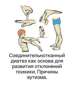 Соединительный диатез как основа для&hellip;