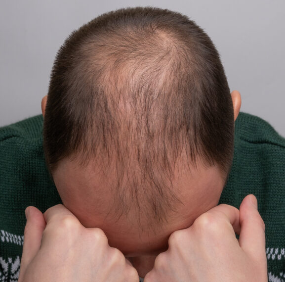 Если вы перешли на лысую&hellip;