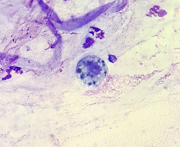 Труженник макрофаг. Мокрота. Окраска по Романовскому-Гимзе 2 37ff2acec41cd714492c7982c234b47d.jpg