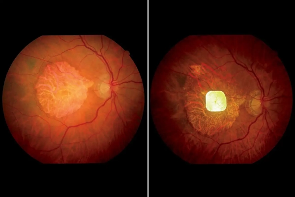 Глаз участника исследования без ретинального имплантата (слева) и с ретинальным имплантатом (справа)