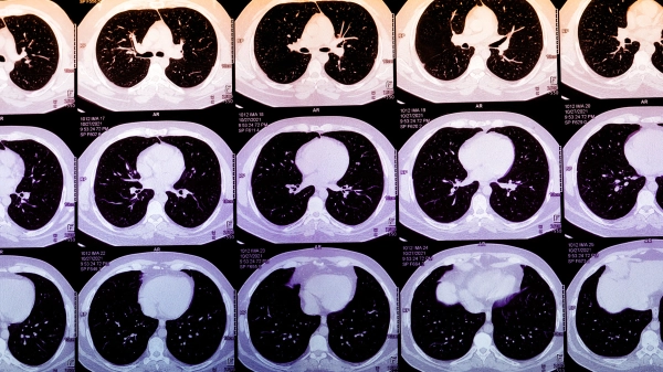 ИИ может предсказать, у кого случится сердечный приступ