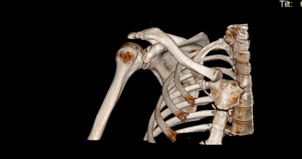 КТ плечевого сустава