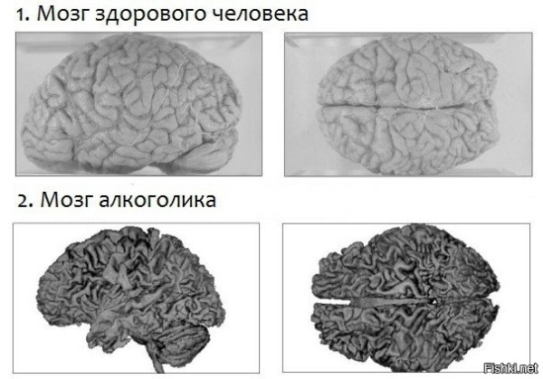 Как выглядит мозг алкоголика изнутри: Взгляд патологоанатома, который заставит задуматься 2 a6caf8127452af2f85d21617fcecc063.jpg