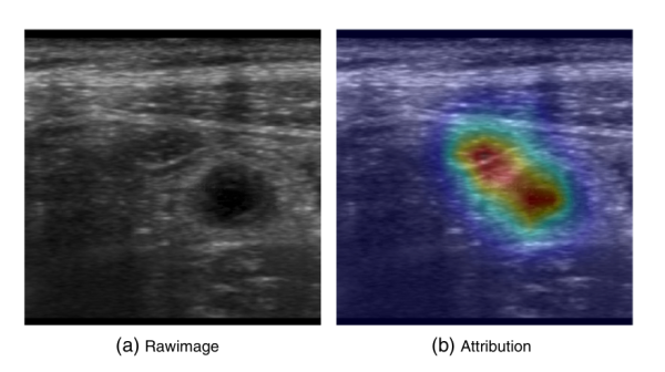Пример использования атрибуции в классификации медицинских изображений. Согласно карте атрибуции, классификатор концентрируется на области вокруг аппендикса. Источник изображения Пример использования атрибуции в классификации медицинских изображений. Согласно карте атрибуции, классификатор концентрируется на области вокруг аппендикса. Источник изображения