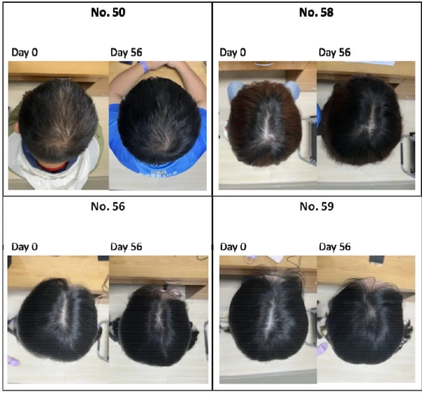 Улучшение роста волос у разных участников пятой группы после 56 дней использования сыворотки