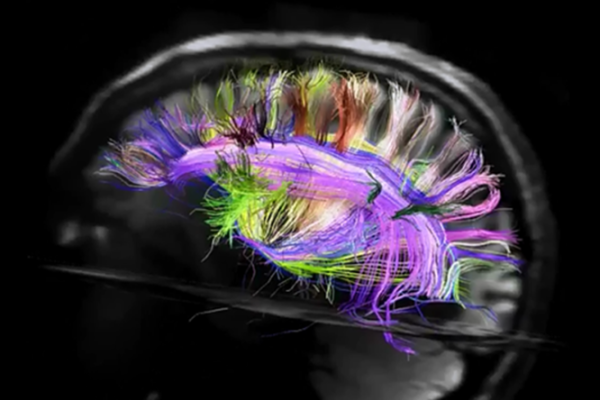 МРТ мозга человека