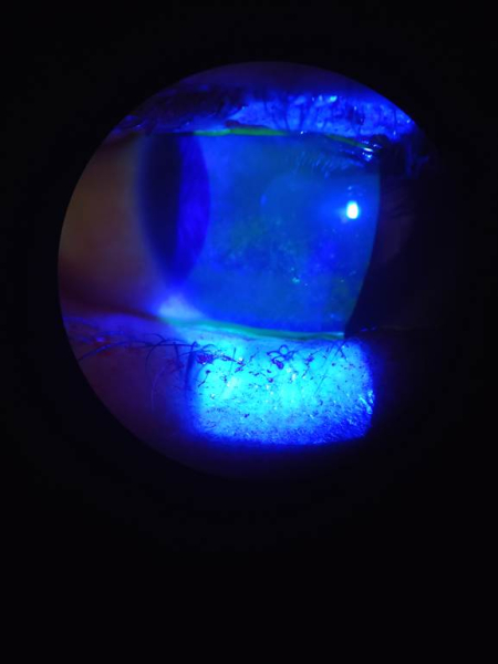 Так выглядит точечный кератит, лёгкий вариант сухого глаза