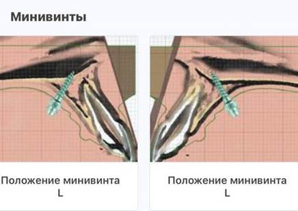 Проектирование перед установкой аппарата