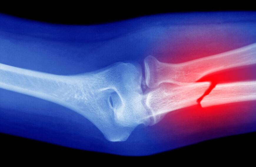 Модифицированный клеевой пистолет распыляет материал, который помогает залечить&hellip;