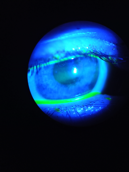 Нормальный мениск