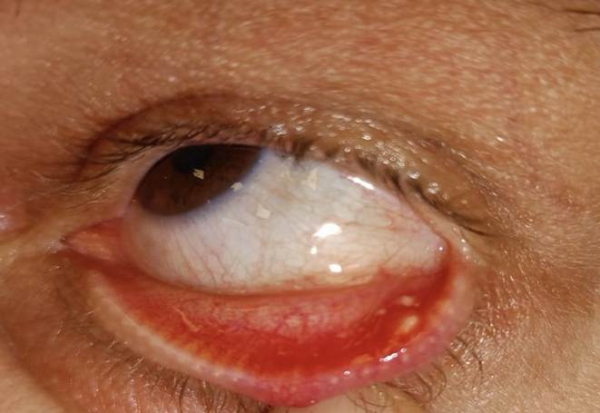 По нижнему веку закупоренные мейбомиевы железы, а в правом углу — халязион