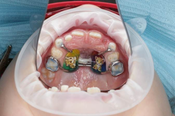 Аппарат спустя две недели активаций (кручений)