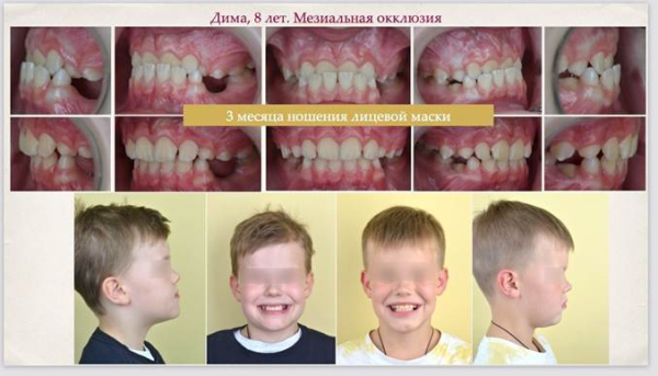 Результаты лечения Димы (динамика за три месяца)