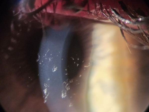 Нитчатый кератит