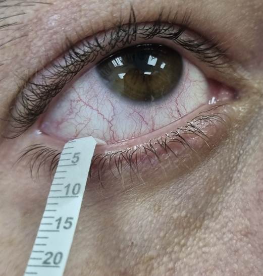 Тест Ширмера