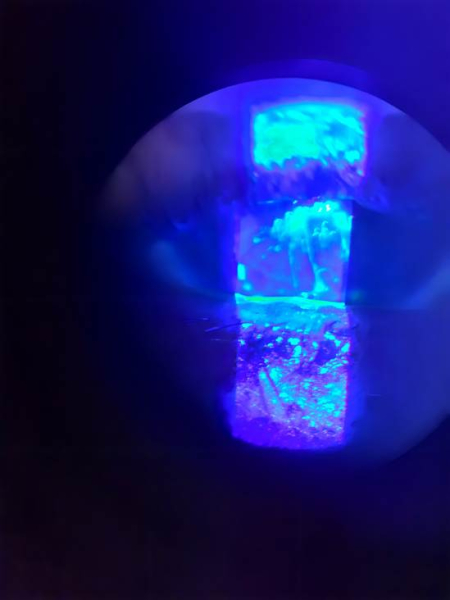 Вариант более тяжёлого нитчатого кератита с центральной язвой