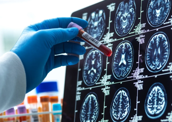 Анализы крови на болезнь Альцгеймера уже здесь 2 c742ae4d43e2bbaea2f1ad446bb444f2.jpg
