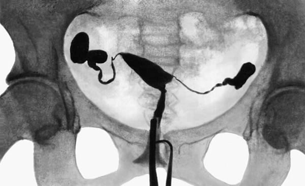 Гистеросальпингография Гистеросальпингография