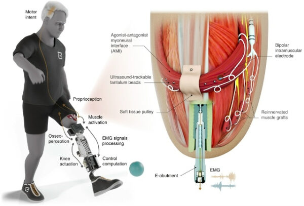 Протезирование ноги: схема мышц и электродов для управления движением.