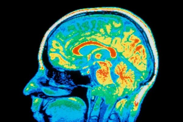 Тепловая карта МРТ мозга: цветная томограмма головы человека.