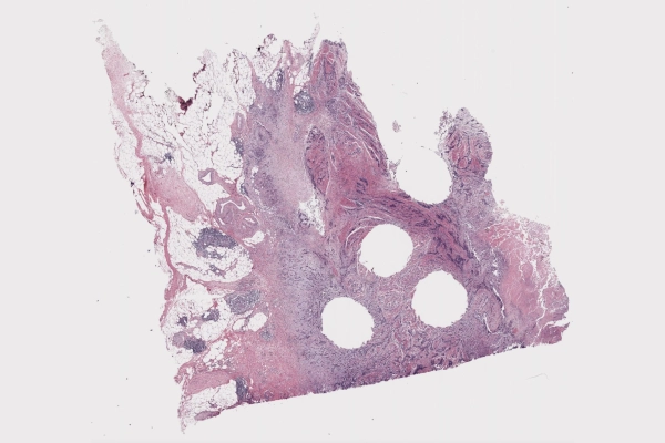 Микроснимок ткани со структурными изменениями, вероятно, для медицинского исследования.