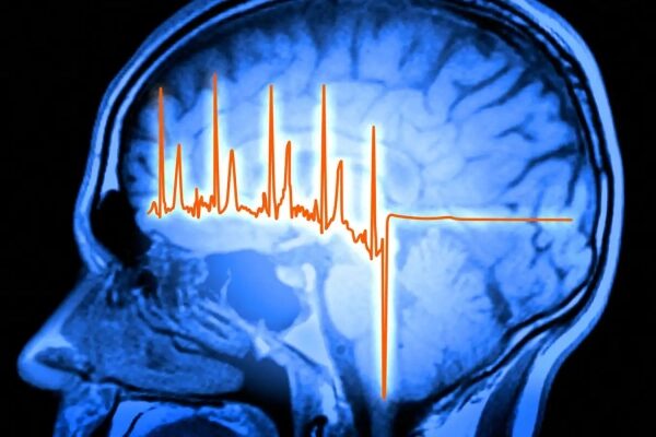 Мозг человека на МРТ с наложенной ЭЭГ, показывающей активность.