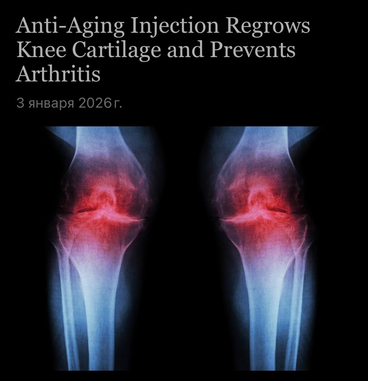 Учёные нашли способ заново вырастить хрящ в суставе. С возрастом... 3 Рентген коленей, инъекции против старения восстанавливают хрящи и предотвращают артрит.