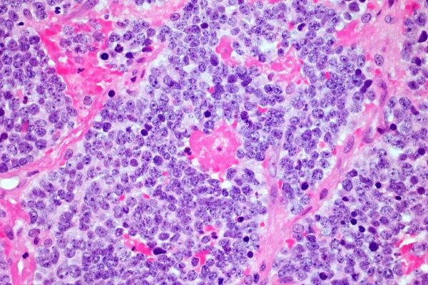 Терапия CAR T-клетками может замедлить развитие нейродегенеративных заболеваний, таких как боковой амиотрофический склероз (БАС). 3 3605051f69cd104e42fb01e482285901