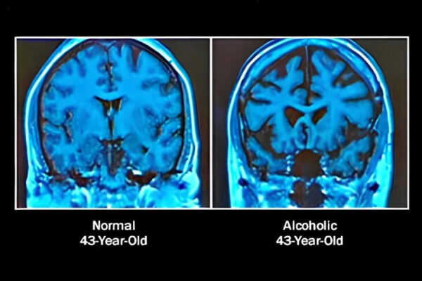 Многолетнее употребление алкоголя меняет экспрессию генов в ключевых областях человеческого мозга - выяснили испанские нейробиологи и генетики 2 Сканирование мозга: сравнение нормального и алкоголика, 43 года.