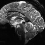 МРТ сканирование головного мозга в сагиттальной проекции: структура и детали.