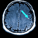 Сканирование мозга: МРТ с выявлением аномалии, выделенной стрелкой.