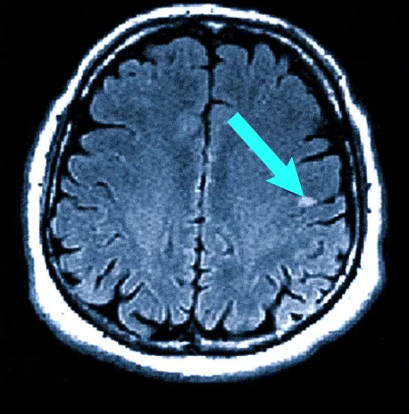 Сканирование мозга: МРТ с выявлением аномалии, выделенной стрелкой.