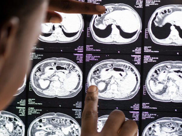 Обычная физическая активность увеличила объём серого вещества 1 Медицинские рентгеновские снимки, доктор анализирует результаты исследований.