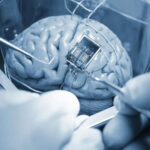 Операция по вживлению чипа в мозг с использованием хирургических инструментов.