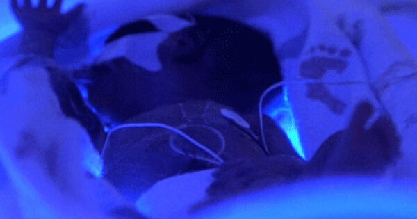 Новорожденный в инкубаторе с фототерапией под синим светом.