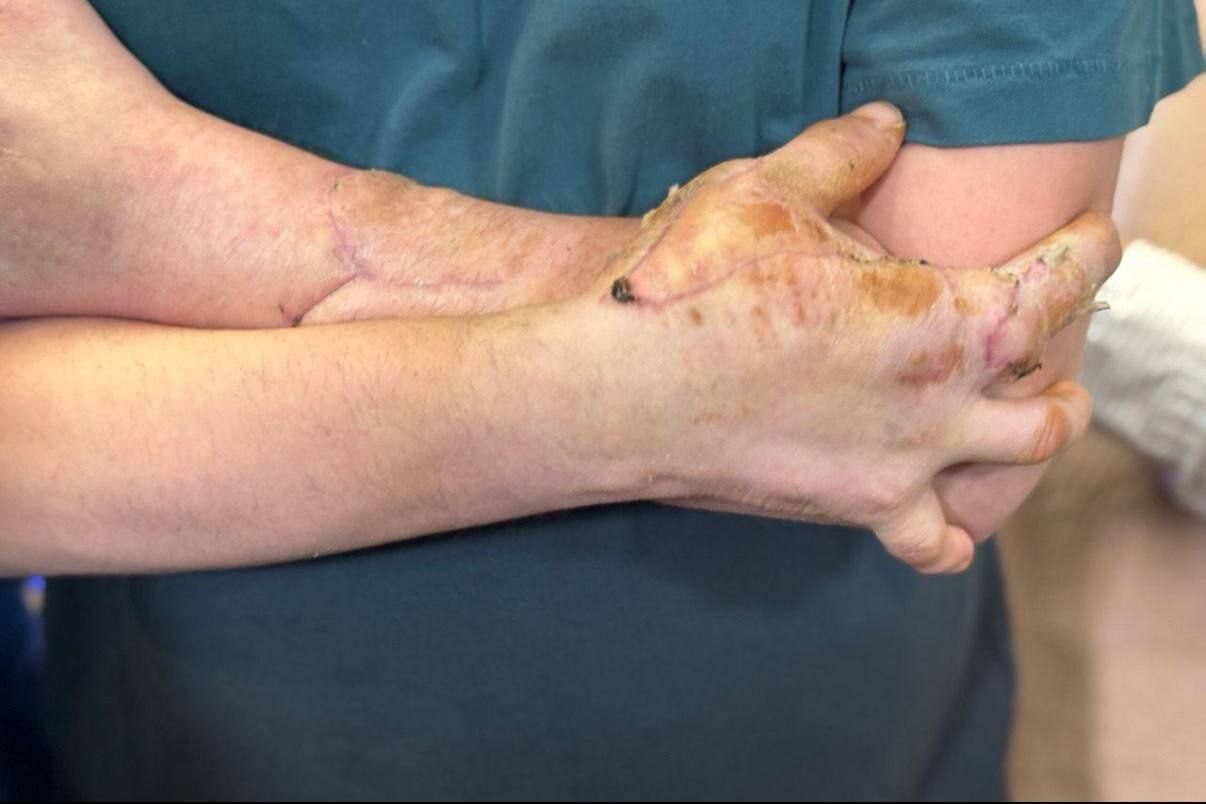 Руки человека после пересадки кожи, рубцы и изменения текстуры кожи.