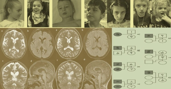 Высокий уровень свинца в костях связали с повышенной сердечно-сосудистой смертностью. Металл повлиял на 3,5 миллиона смертей в 2023 году 1 9de67cf6d1aa8c5389bc9bf0c898ba11