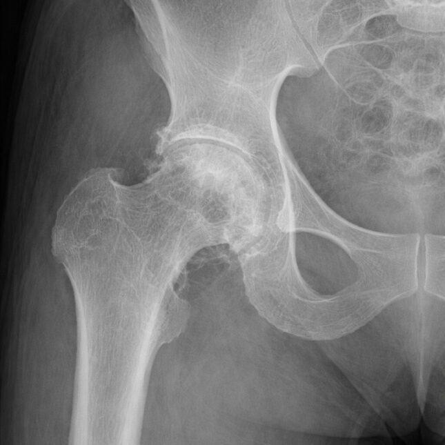 STAT+: Можете ли вы распознать поддельный рентгеновский снимок? Ваш рентгенолог тоже не сможет. 1 Синтетический рентгеновский снимок тазобедренного сустава, созданный Микаэлем Торджманом с помощью Chat GPT.