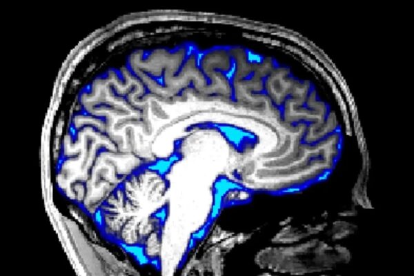 Новый подход к удалению отходов из мозга демонстрирует многообещающие результаты в лечении болезни Альцгеймера. 3 cafa142c51c7cac08751c08424490e97
