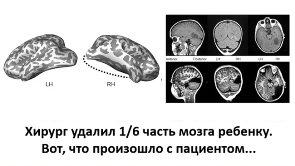 Случай 11-летнего мальчика демонстрирует удивительную пластичность детского мозга